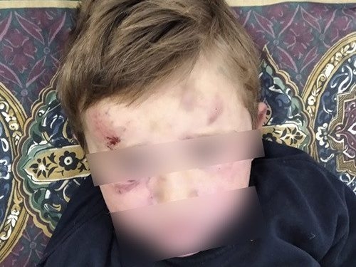 На Тернопільщині судитимуть вітчима, який знущався з дитини: зламав руку і кинув об землю