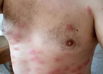 Сумна історія з укриттями в Тернополі: чоловіка, який допомагав прибирати підвал будинку, покусали блохи