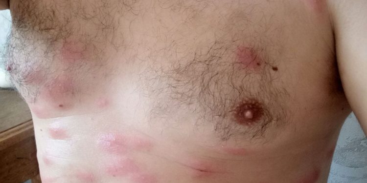 Сумна історія з укриттями в Тернополі: чоловіка, який допомагав прибирати підвал будинку, покусали блохи