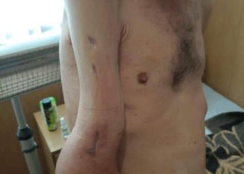 У героя Маріуполя не вистачає 4 см кістки в руці: як виглядає звільнений з полону морпіх Михайло Діанов