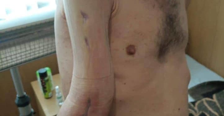 У героя Маріуполя не вистачає 4 см кістки в руці: як виглядає звільнений з полону морпіх Михайло Діанов