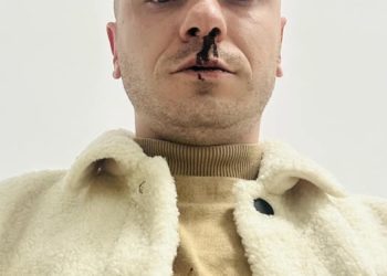 З розбитим носом: Активіст Роман Довбенко розповів деталі інциденту у Бучачі